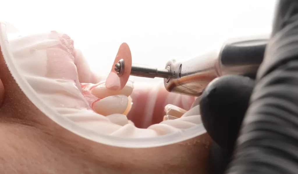 پولیش دندان